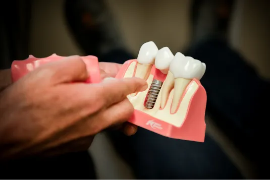 model of teeth